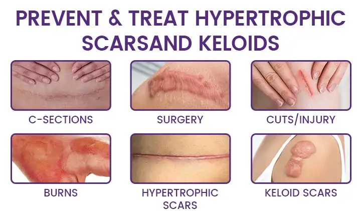 🔥 LIMITED SPECIAL OFFER Grunsify Scar Repair Gel